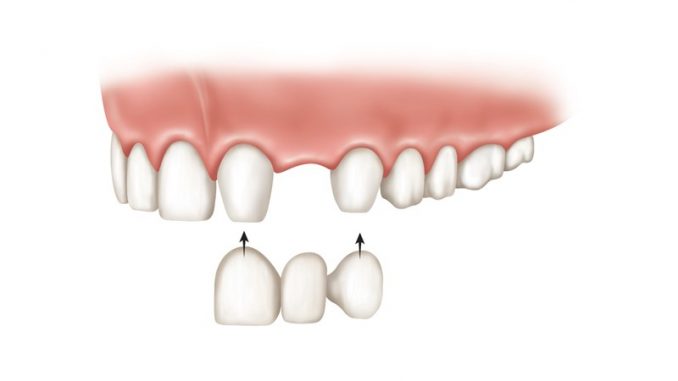 alternative-to-dental-implants