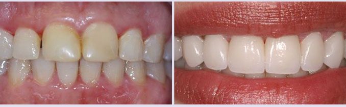 before-and-after-dental-work