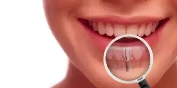 best dental implants near me