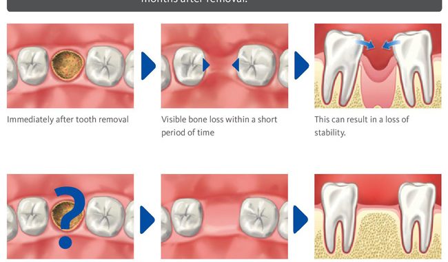 bone-graft-dental-side-effects