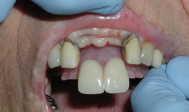 can-you-eat-with-flipper-teeth