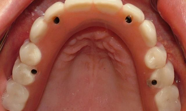 cheapest-way-to-do-an-all-on-four-dental-implant