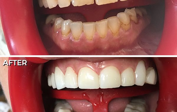cosmetic-dentistry-in-mexico