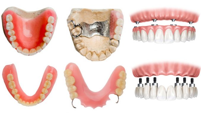 cost-of-full-dentures