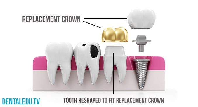 crown-replacement-costs