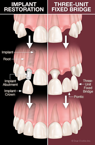 Crown Versus Implant Dental News Network
