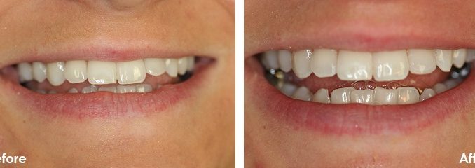 dental-bonding-before-and-after