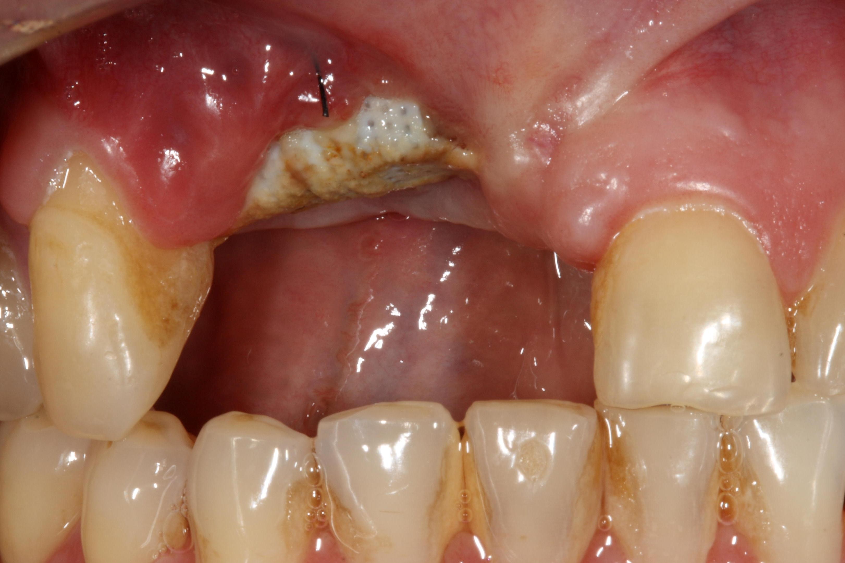 alarming-rise-in-dental-diseases-to-propel-adoption-of-dental-membrane