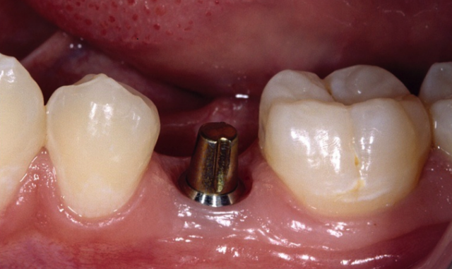 dental-implant-crowns