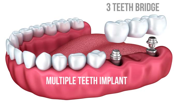 dental-implant-prices-dental-news-network