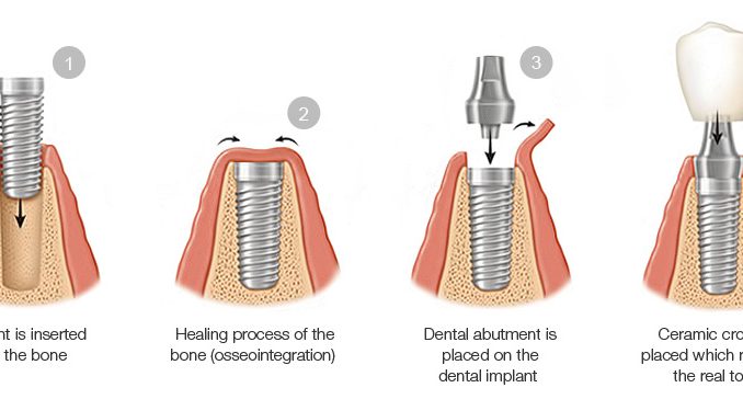 dental-implant-steps