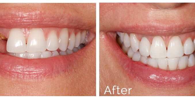 dental-implants-atlanta-ga