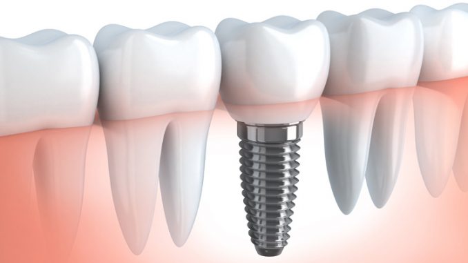 dental-implants-boca-raton