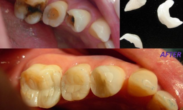 dental-inlay-cost