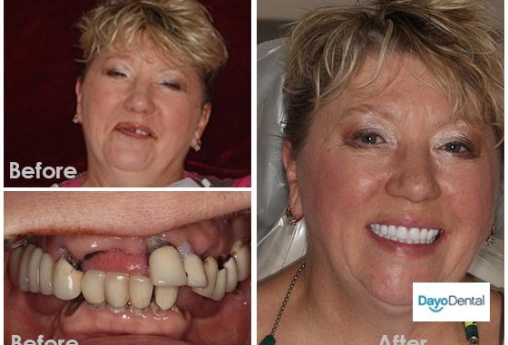 denture-before-and-after-pictures