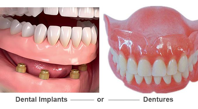 dentures-vs-implants-pros-cons