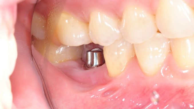 do-teeth-implants-hurt