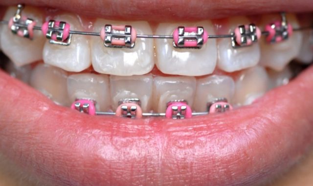 fake-braces-for-sale