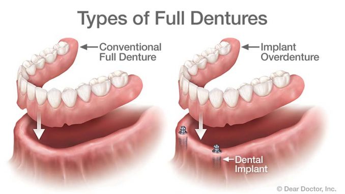 how-do-dentures-work