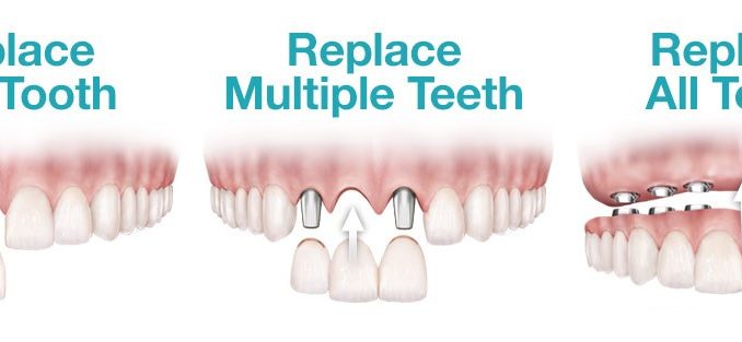 new-tooth-cost