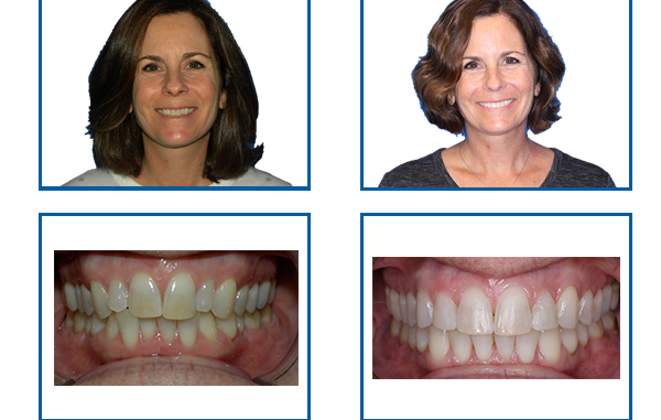 smile-after-braces