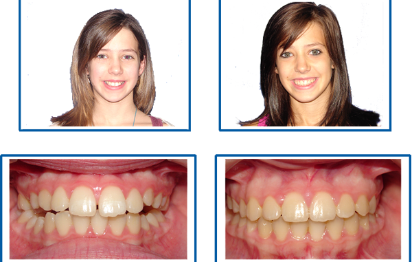 smiles-after-braces