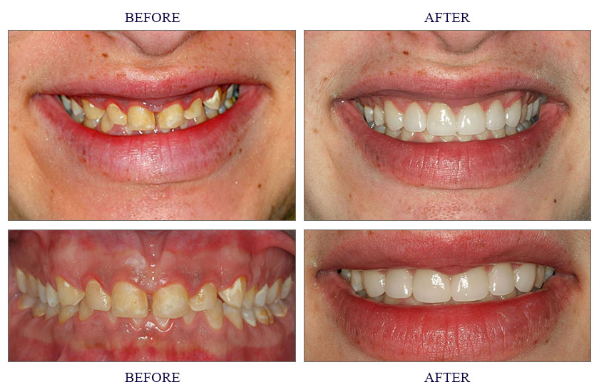 Teeth Cap Before And After