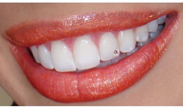 tooth-extensions