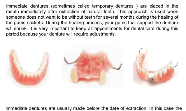 tooth-extraction-for-dentures-recovery-time