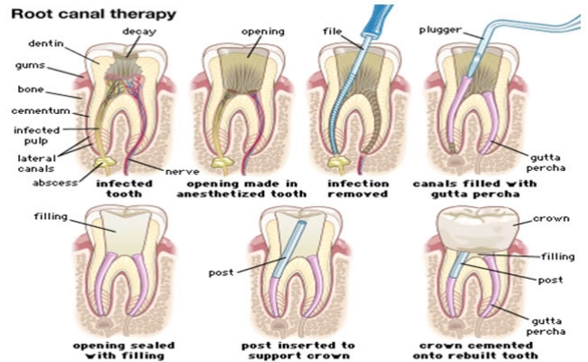 dental treatment for tooth decay