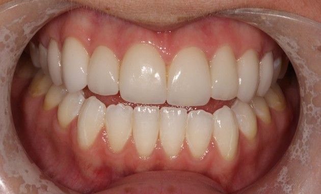 veneers-after-braces