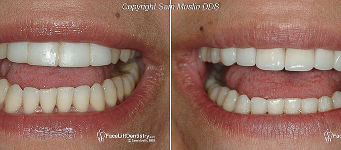 what-are-fake-teeth-made-of