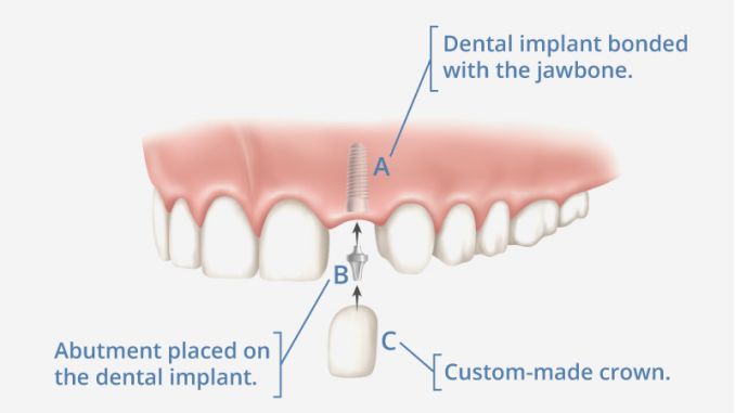 what-is-a-tooth-implant