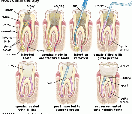 what-is-an-endodontist-vs-dentist