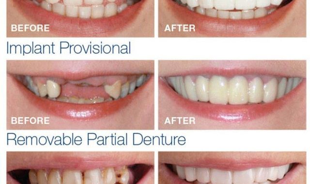 whitening-fake-teeth
