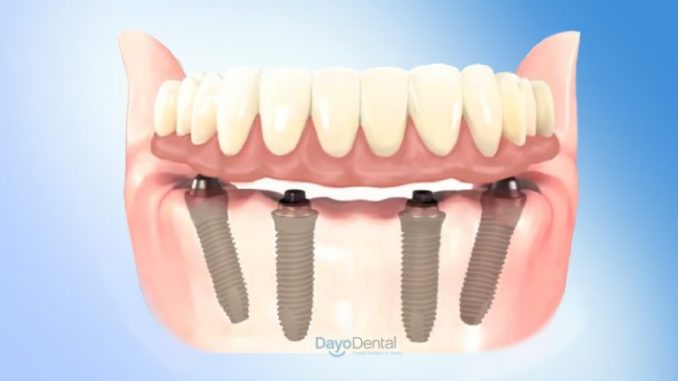 all-on-4-dental-implants-mexico