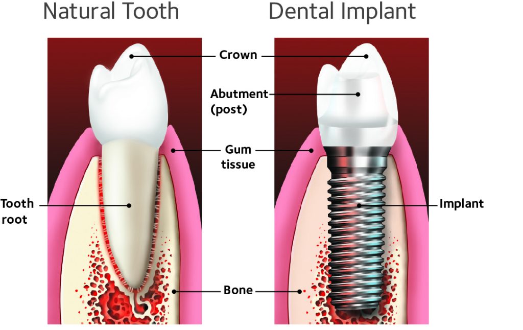 Aspen Dental Implants - Dental News Network