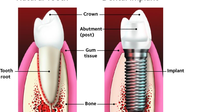 aspen-dental-implants