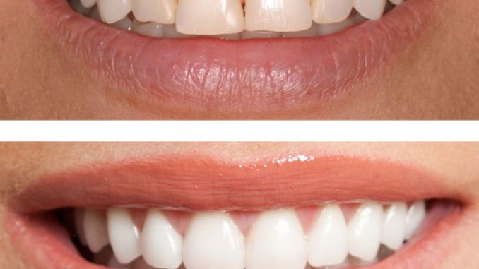 bonded-teeth-pictures