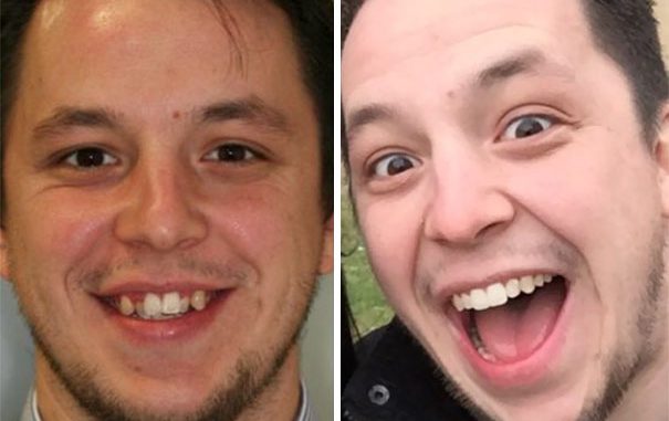 brace-before-and-after-pictures