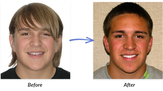 braces-before-and-after-pictures