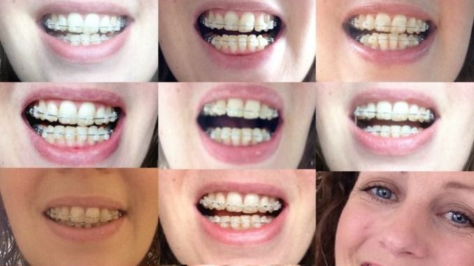 braces-transformation