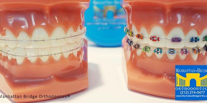 bridge-braces