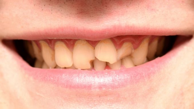 can-a-chipped-tooth-heal