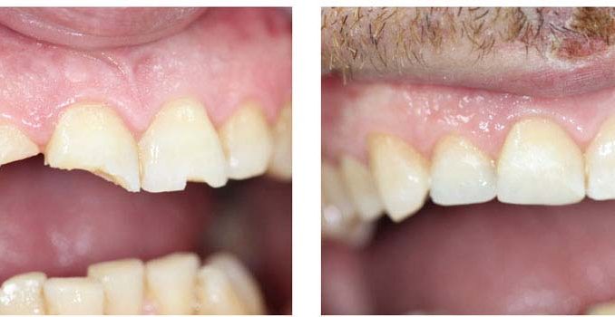 chipped-molar-repair