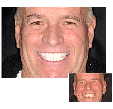 clear-choice-teeth