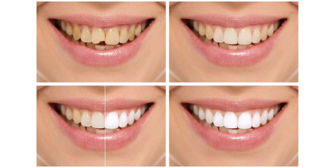 cosmetic-dentistry-toronto