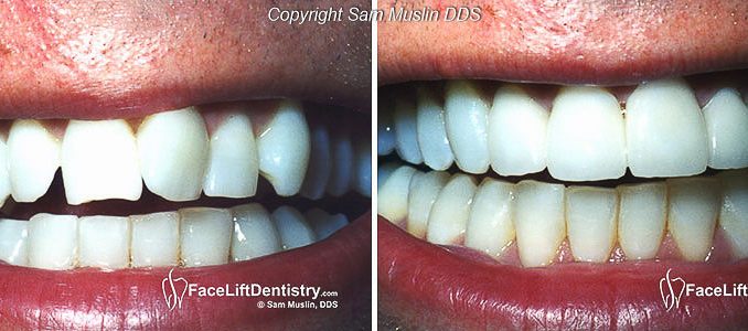 crooked-teeth-before-and-after-braces