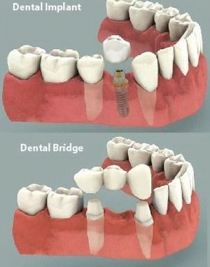 crown-vs-implant