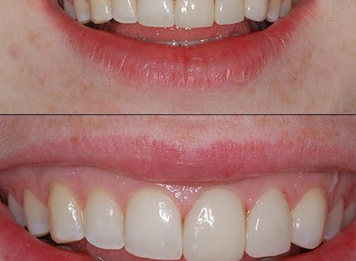 crowns-before-and-after